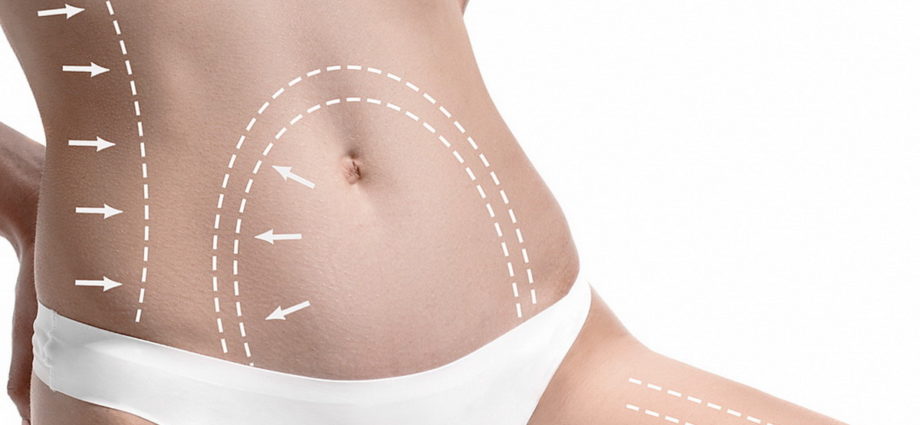 What Makes The Liposuction Surgery Useful For The Patients?
